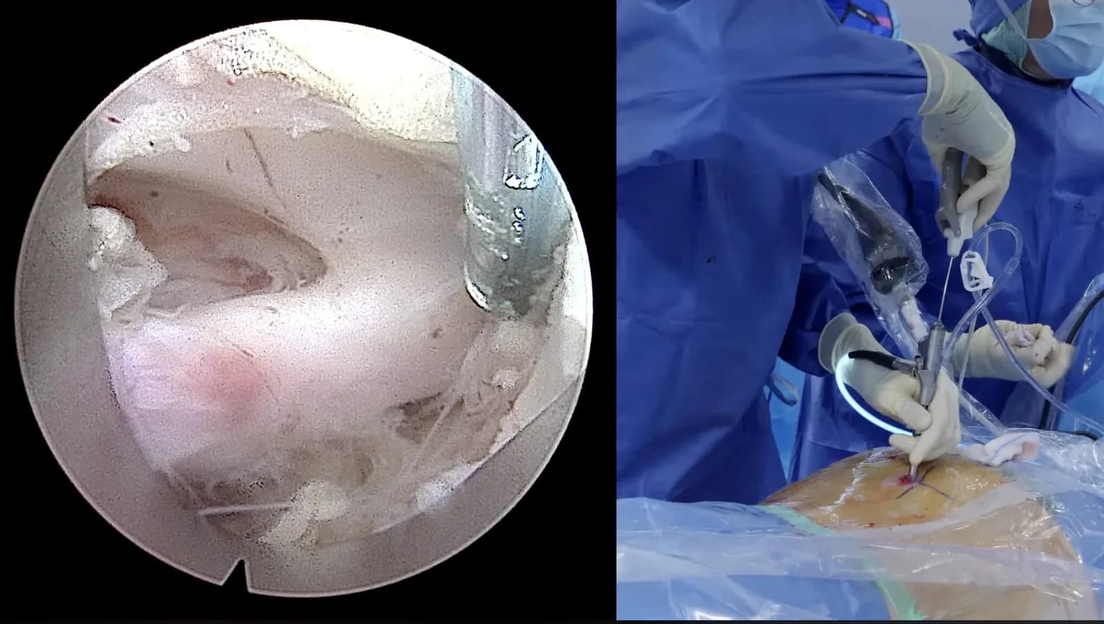 Chirurgie endoscopique d’une hernie discale lombaire retransmise lors de la Santy Live Surgery : vue endoscopique à gauche, geste opératoire au bloc à droite.