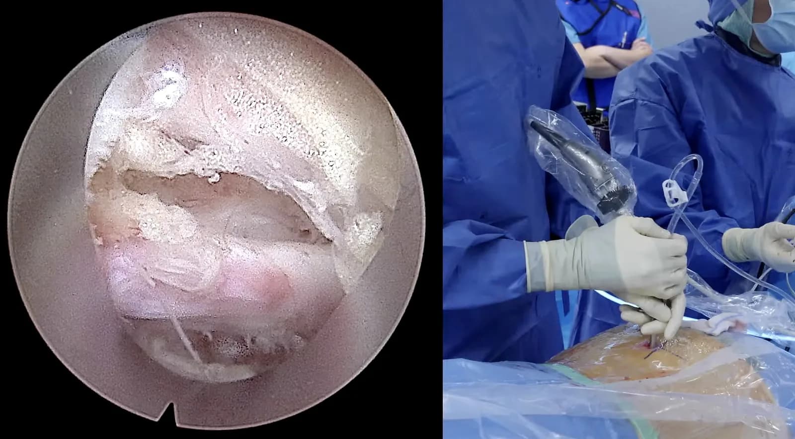 Santy Live Surgery à Lyon : image endoscopique peropératoire et chirurgiens au bloc pendant la discectomie endoscopique lombaire.