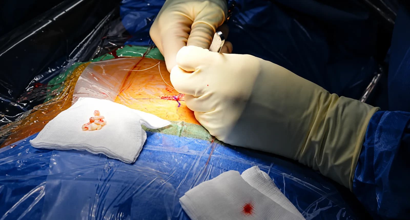 Fermeture cutanée en fin de discectomie endoscopique lombaire, fragments de hernie discale retirés sur une compresse.
