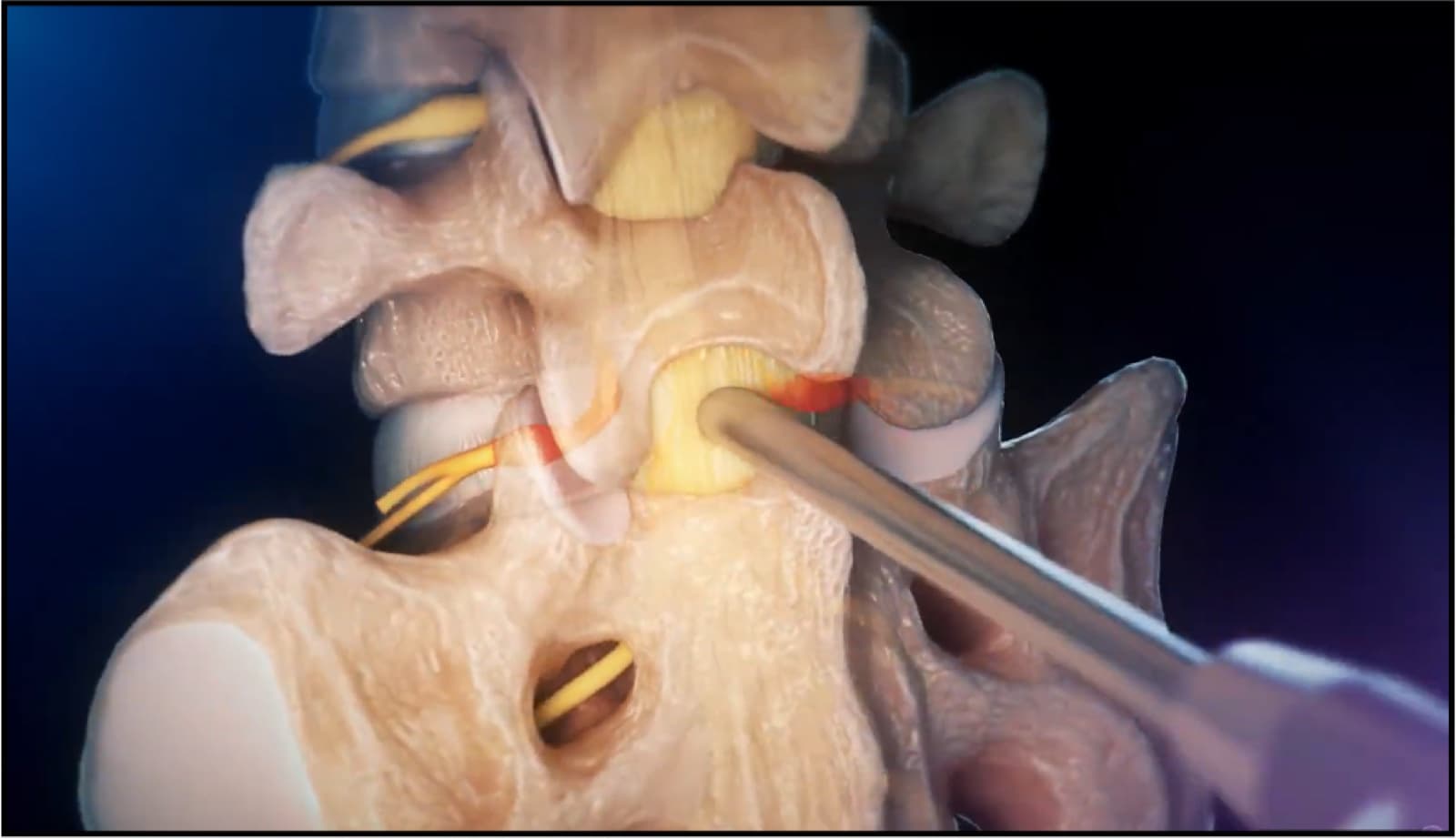 Illustration de l'abord interlaminaire endoscopique entre deux lames vertébrales