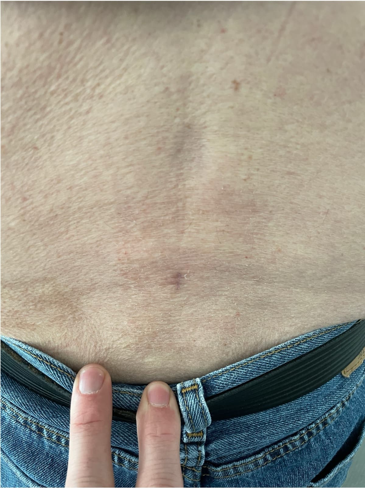 Cicatrice centimétrique dans le bas du dos après chirurgie endoscopique du rachis