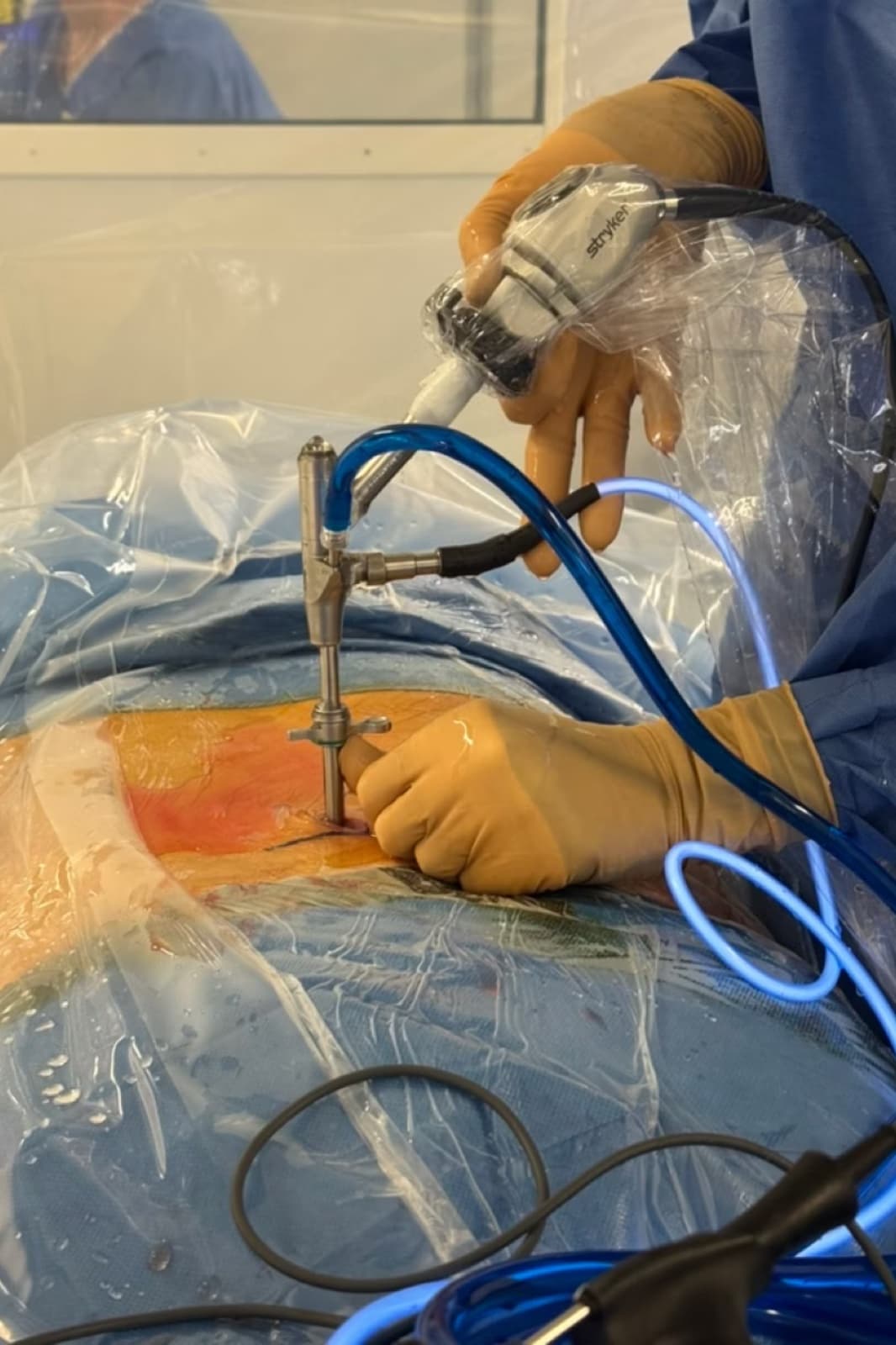 Endoscope du rachis introduit dans le dos du patient au bloc opératoire