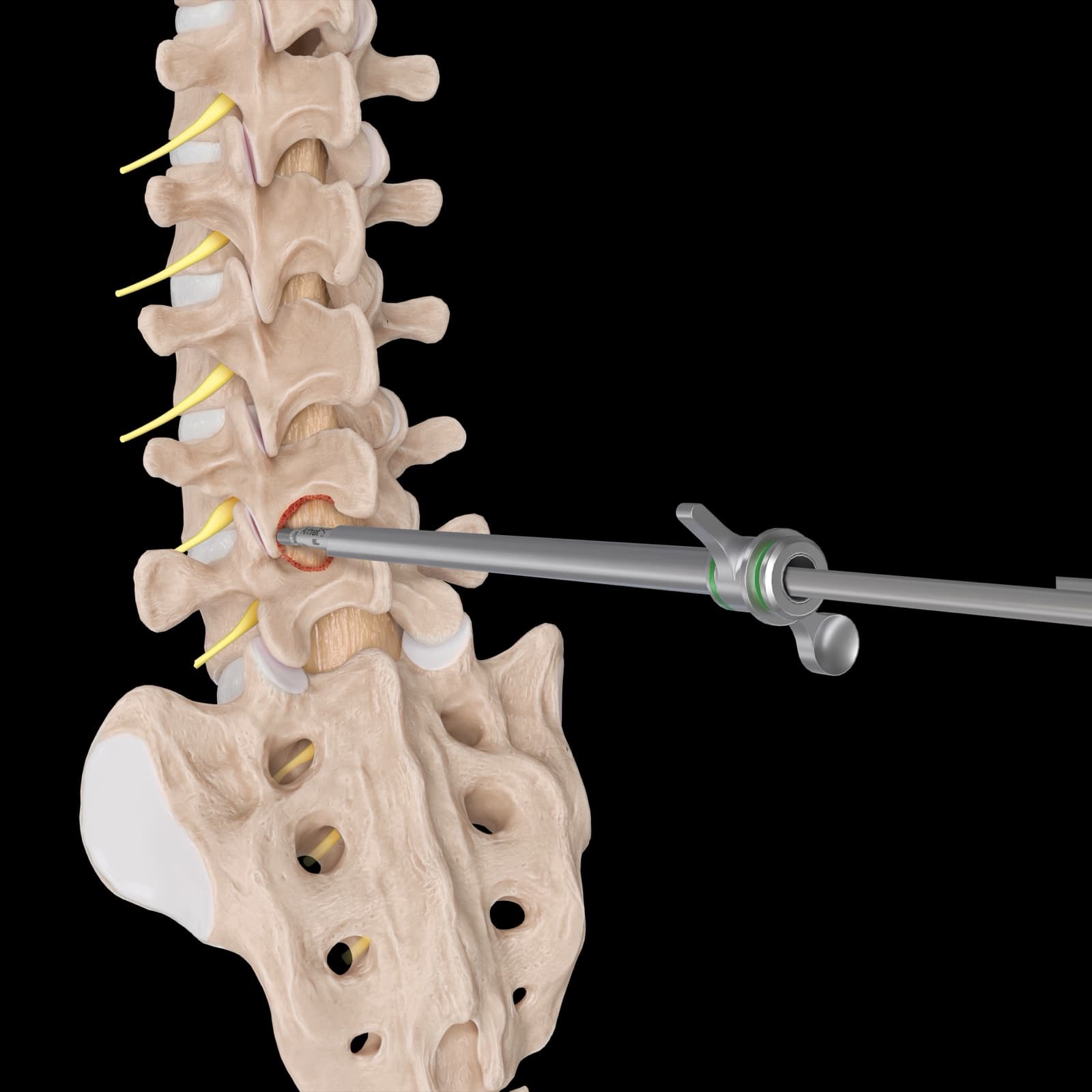 Illustration du recalibrage endoscopique d'un canal lombaire étroit