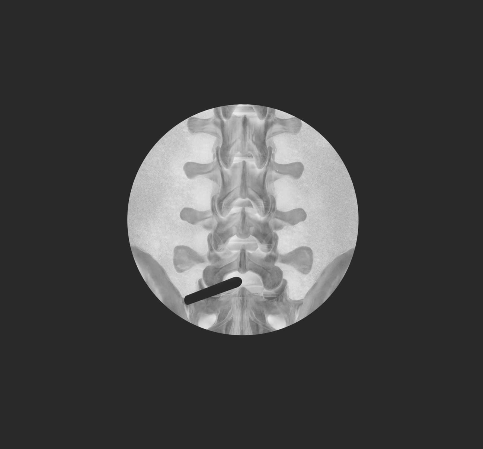 Vue radioscopique per-opératoire du rachis lombaire avec instrument endoscopique