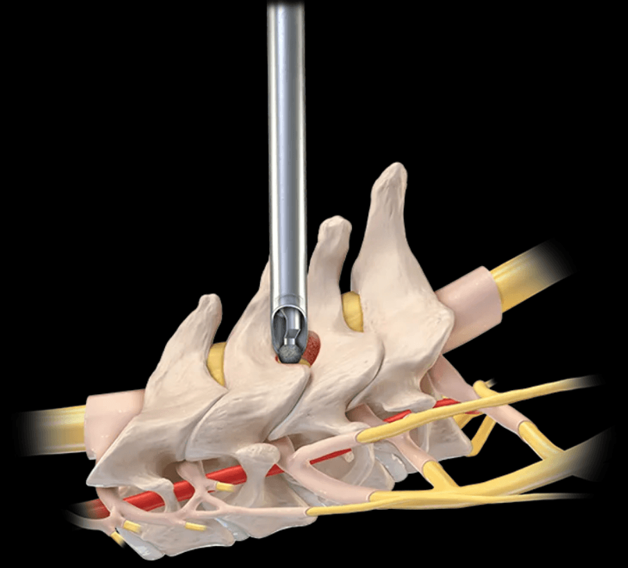 Anatomie d'une racine nerveuse cervicale et abord endoscopique postérieur du foramen