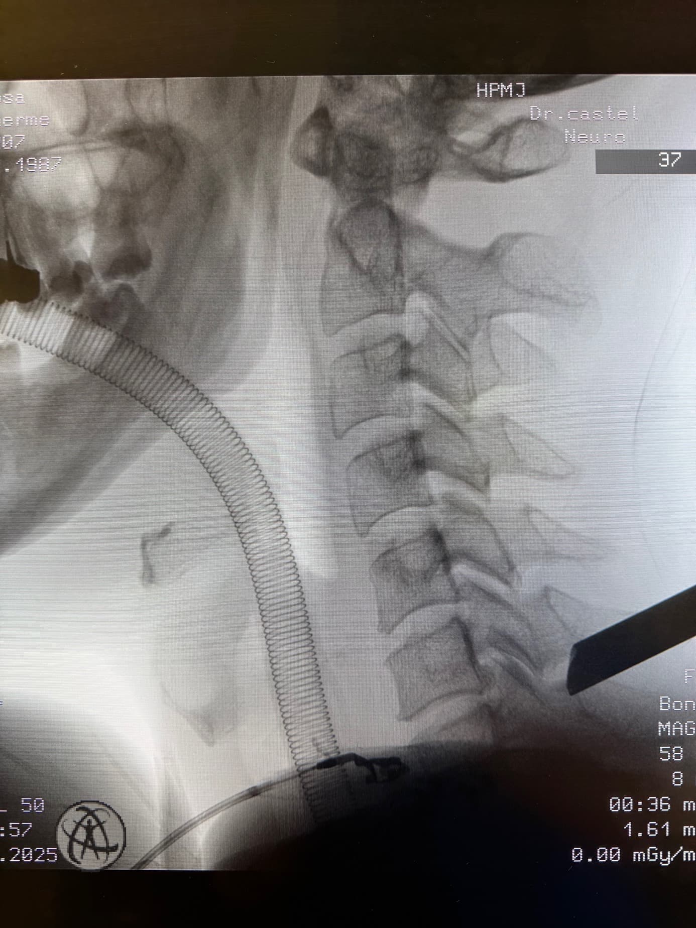 Radiographie peropératoire du rachis cervical au cours de la foraminotomie endoscopique