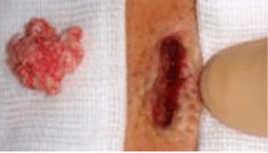Fragment discal réséqué et cicatrice postopératoire après chirurgie de hernie discale lombaire